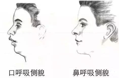 孩子口呼吸症状