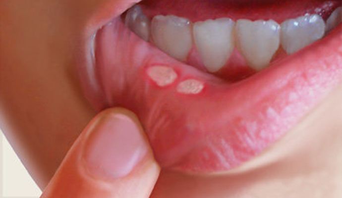 孩子口呼吸症状