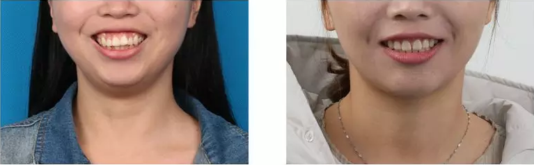 牙齿矫正前后对比